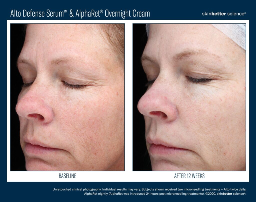 Microneedling-Before-After-Image-of-a-woman-Lennoxaesthetics