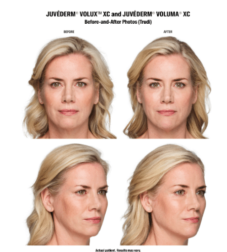 Juverderm-Treatment-Before-and-After-Lennoxaesthetics